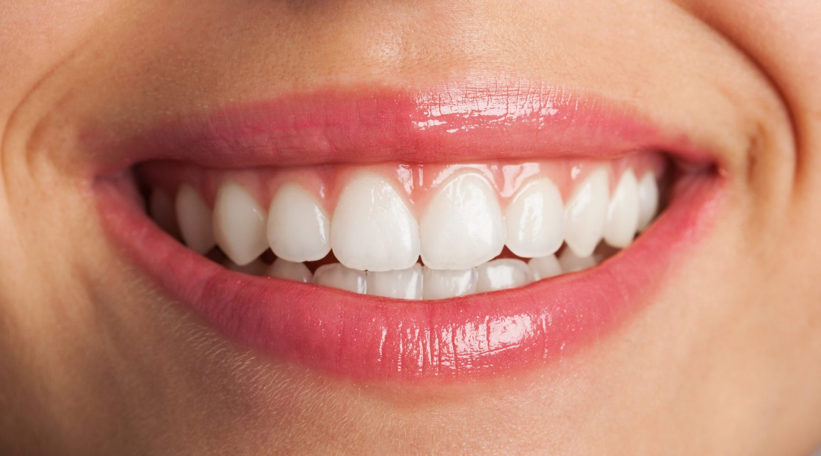 Sorriso harmônico após tratamento estético dental